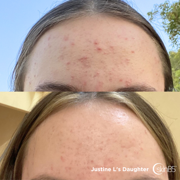 Justine Lovell noticed her daughter's skin has dramatically improved in 3 weeks