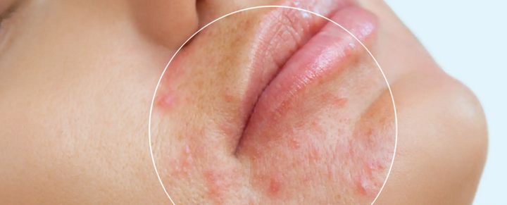 Mouth Pimples: Treatment and Prevention